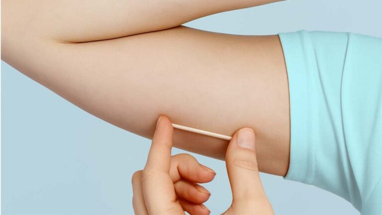 Implanon e acne: existe relação?