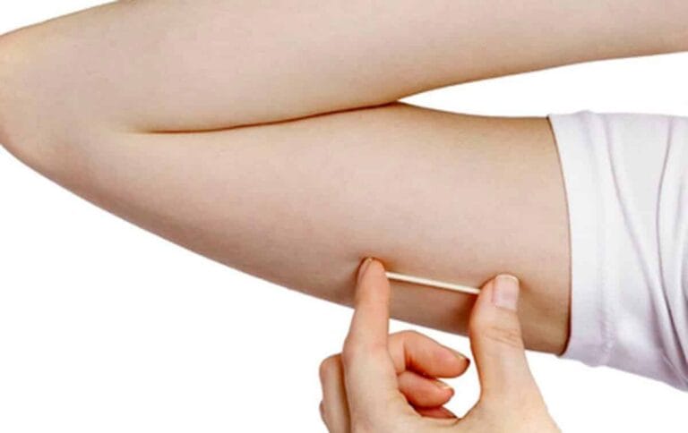 Implanon: Tudo o Que Você Precisa Saber sobre o Implante Contraceptivo