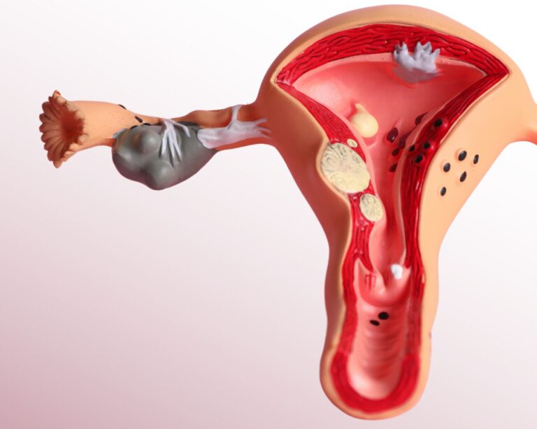Mioma Uterino Pode Desaparecer Sozinho? O Que Você Precisa Saber