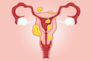 Miomas: qual a indicação médica?