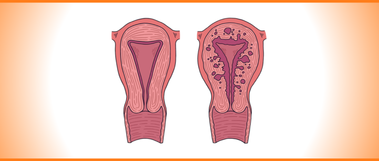 O que é adenomiose, e por que tantas mulheres não recebem o diagnóstico correto