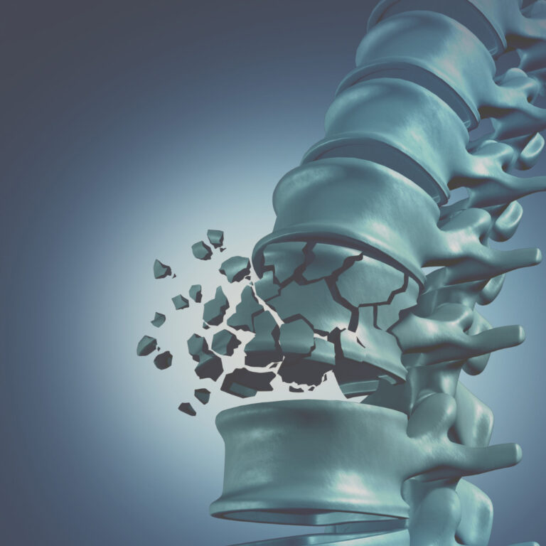 Reposição hormonal na menopausa: impacto na saúde óssea e prevenção da osteoporose