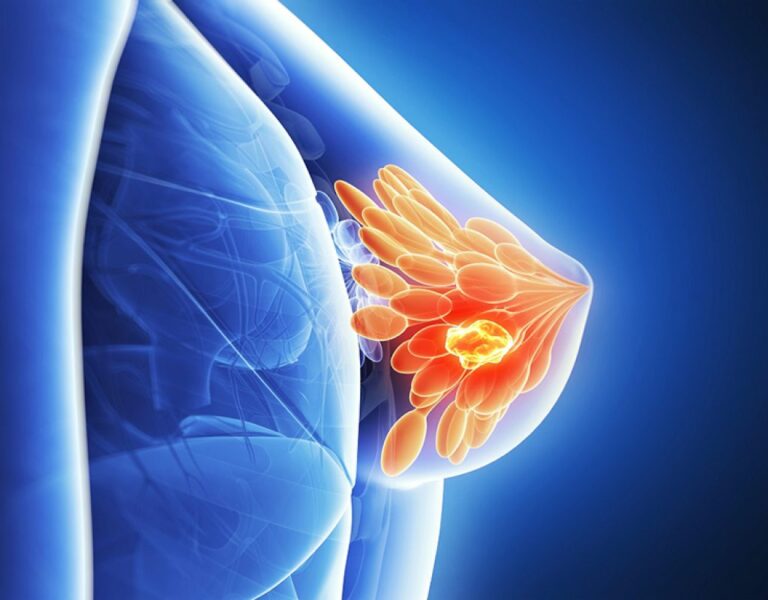 Terapia hormonal e câncer de mama: entendendo os riscos e benefícios