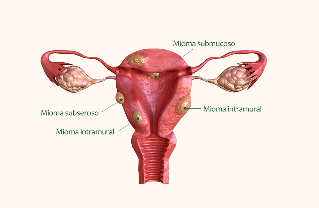 tipos de mioma uterino e suas localizações