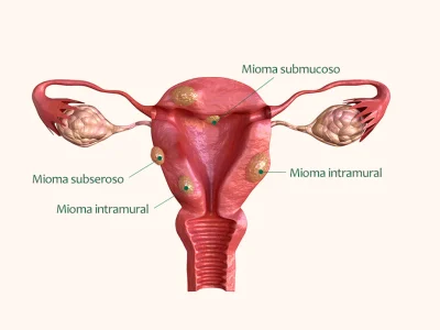tipos de mioma uterino e suas localizações